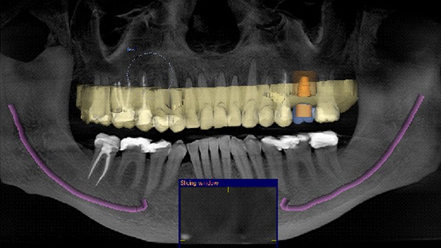dental implants
