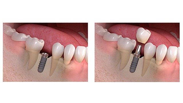 dental implants